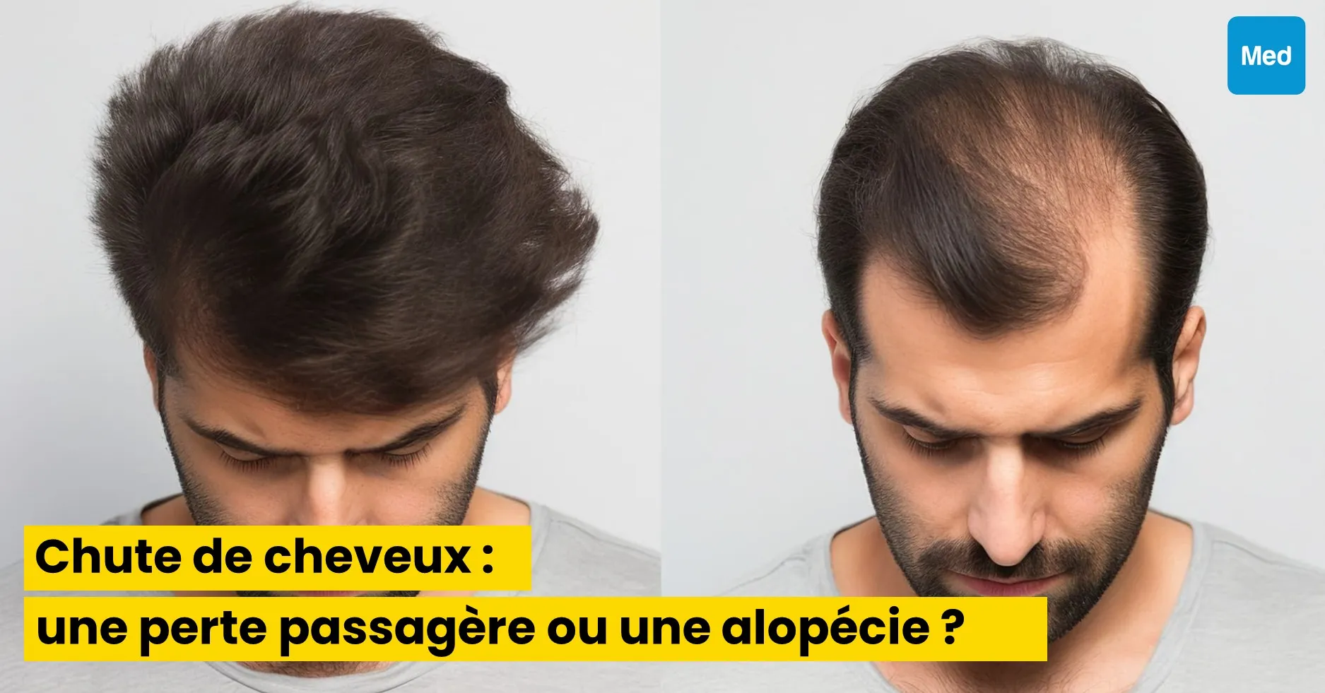 Chute de cheveux : comment distinguer une perte passagère d’une alopécie ?